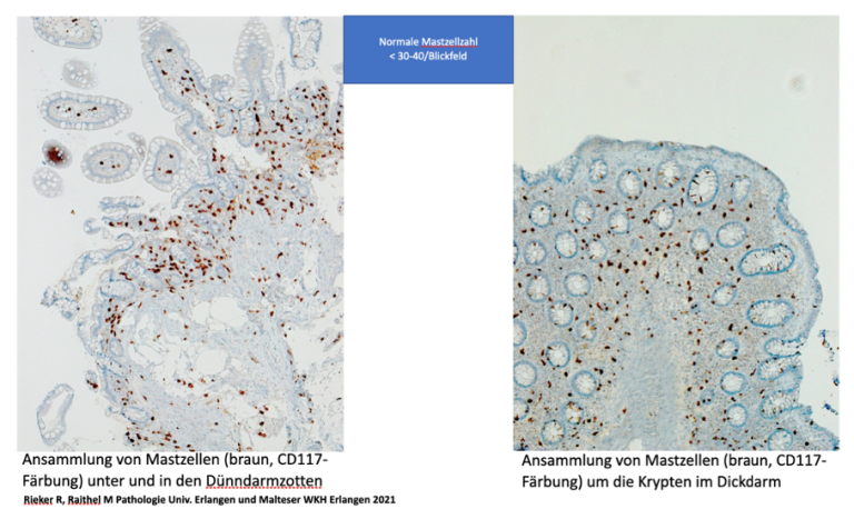 Reizdarmsyndrom und Mastzellen Hilft Dinatriumcromoglycinsäure?